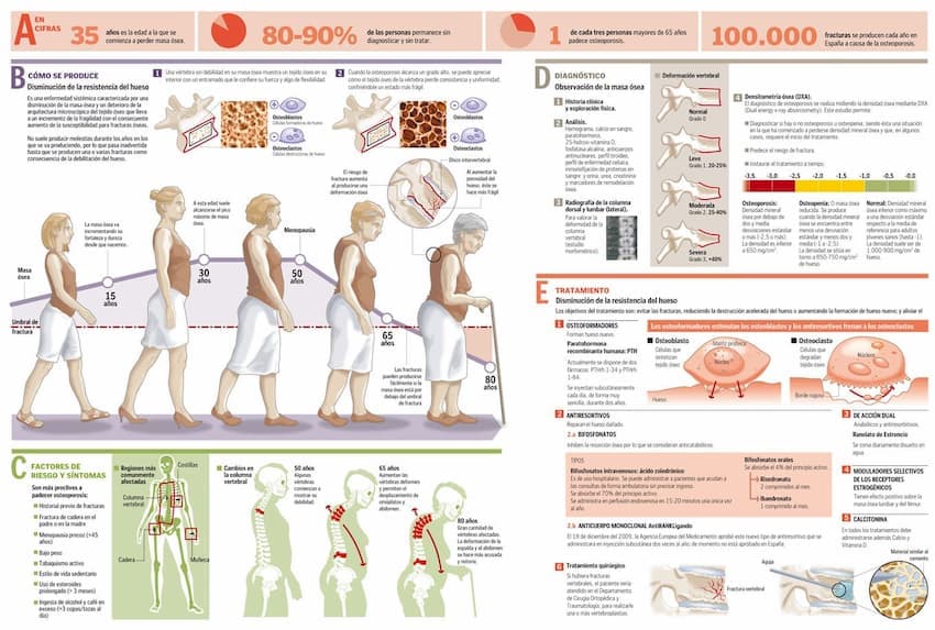 qué-es-la-osteoporosis